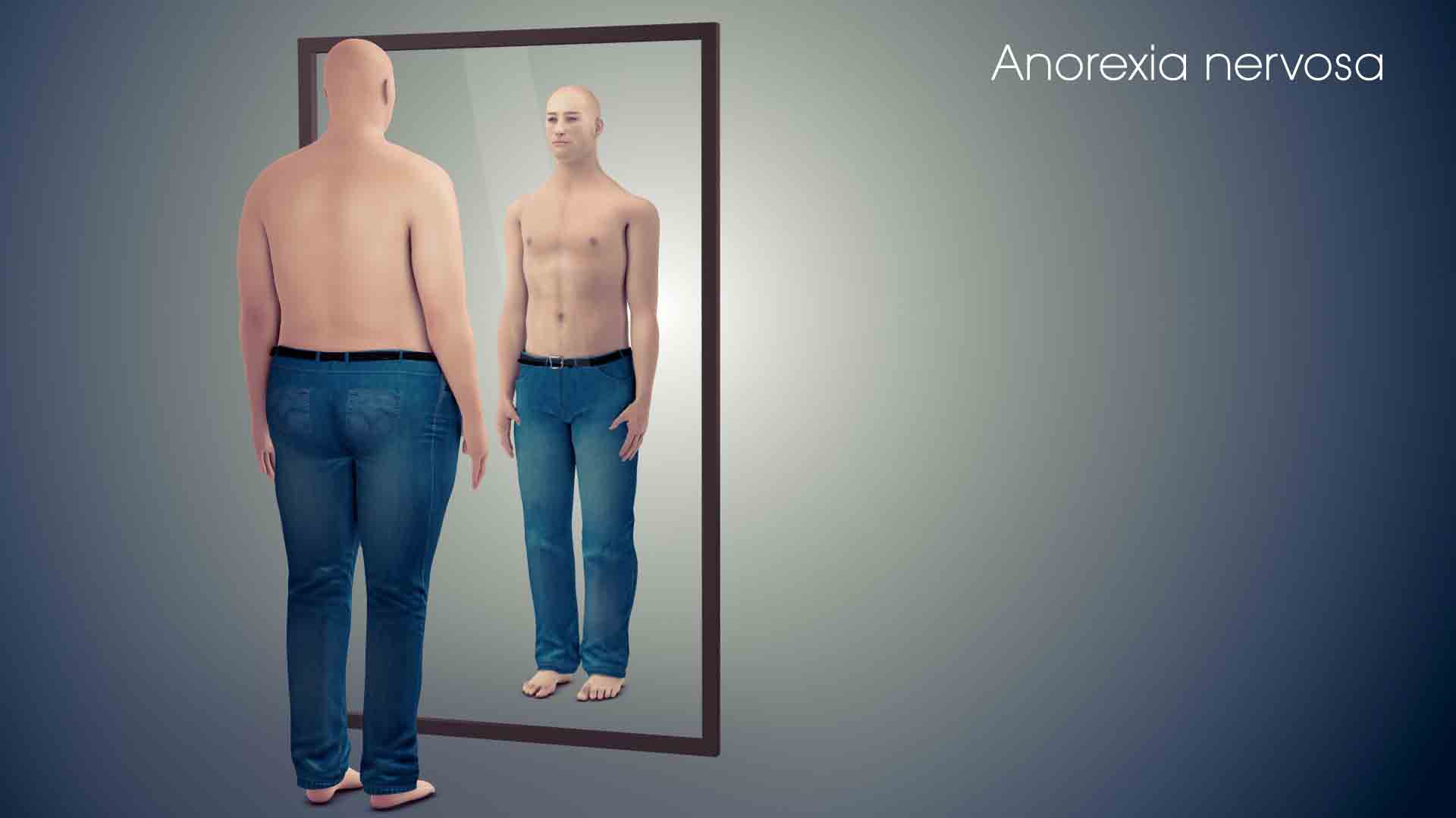 Anorexia Nervosa